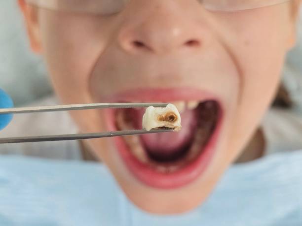 Best Broken or Chipped Tooth Repair in Swarthmore, PA