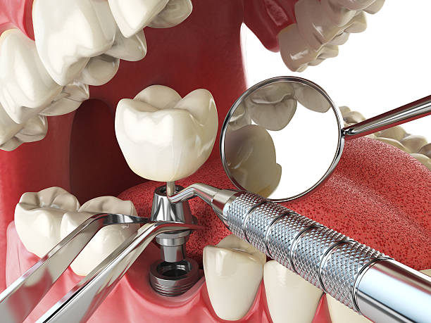 Best Lost Filling or Crown Replacement in Swarthmore, PA